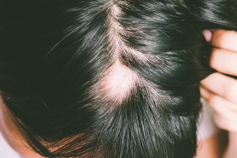 Выпадение волос из пигментного пятна